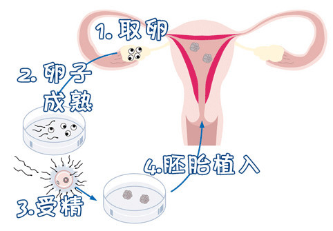 无精症案例